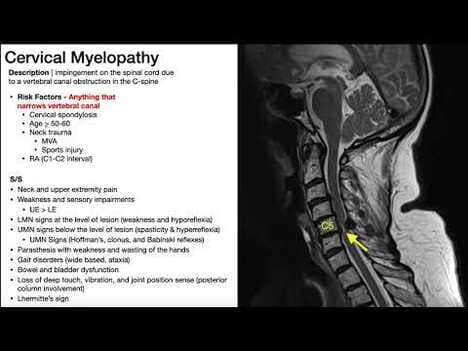 Cauda Equina Syndrome | Presentation, Risk Factors, & Signs/Symptoms