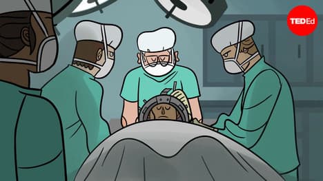 TED-Ed: Can you transplant a head to another body? | Max G. Levy