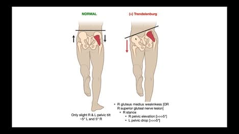 (+) Trendelenburg Sign EXPLAINED